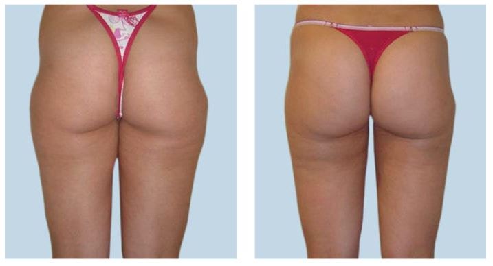 Thigh liposuction Before After