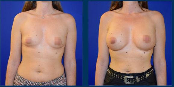 Axillary subfascial breast enlargement - Photos Before After