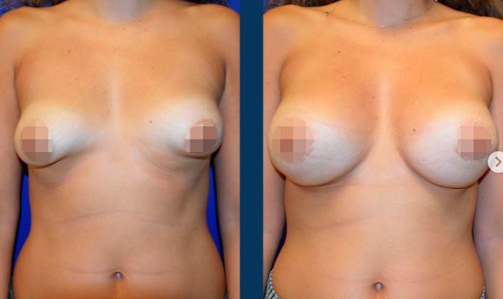 Breast enlargement - Photos before after