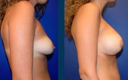 Breast enlargement - Photos before after
