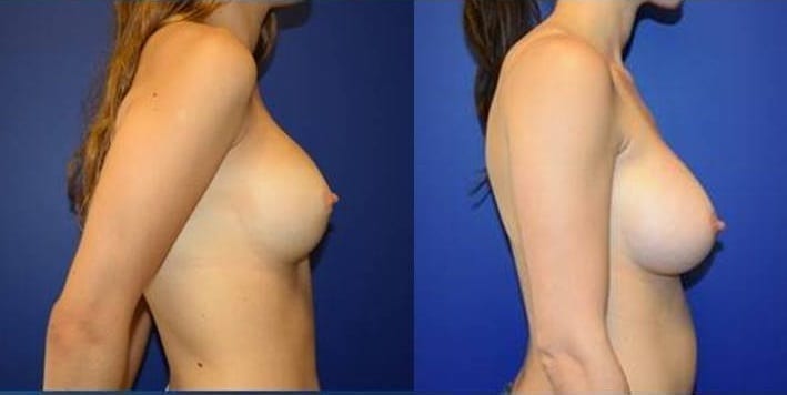 Boob job with round breast implants - Photos Before After