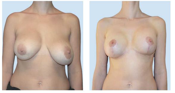 Breast Reduction to correct asymmetry - Photo Before After