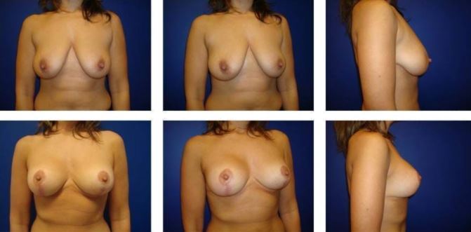 Breast lift Photos before after