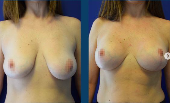 Breast lift Photos before after