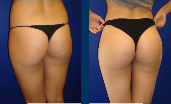 Butt implants - Photos Before After
