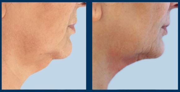 Chin liposuction - Photo before after