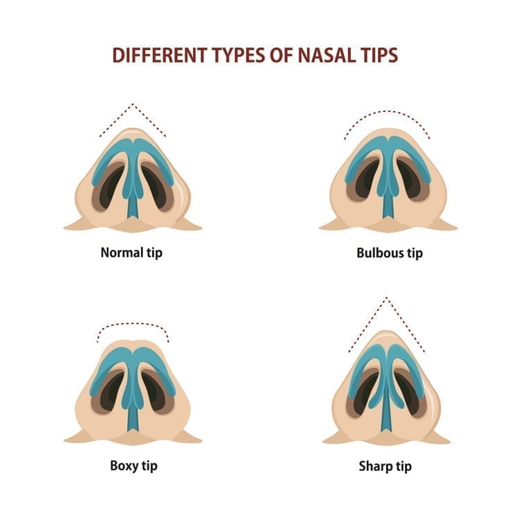 Different Types of Nasal Tips MSB