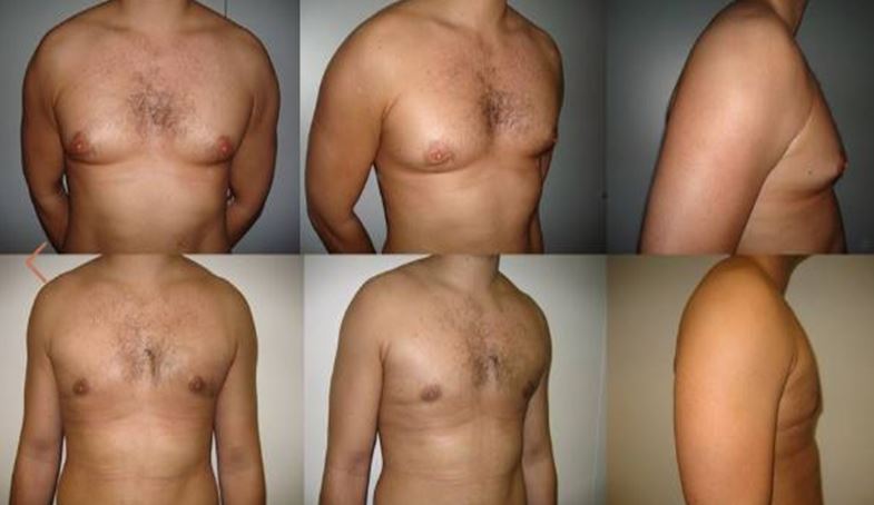 Gynecomastia male breast reduction surgery - Photo Before After