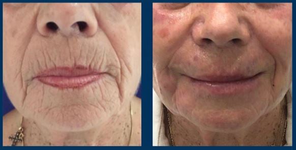 Hyaluronic acid injection face - Photos Before After