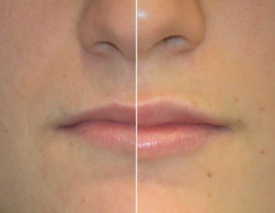 Lip Injections Photo Before and After