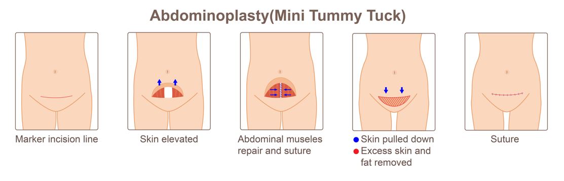 Mini Tummy Tuck Scars