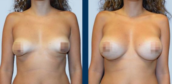 Tubular breasts - Photo Before After