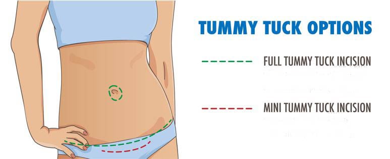 Tummy Tuck vs Mini Tummy Tuck