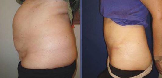 Tummy tuck - Photos before after