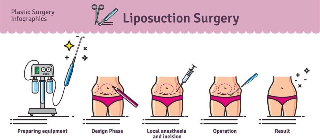 Stomach Liposuction Surgery