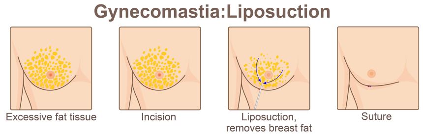 Gynecomastia Surgery Liposuction