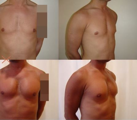 Pectoral Implant - Before After