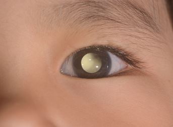 Retinoblastoma Symptoms in Children