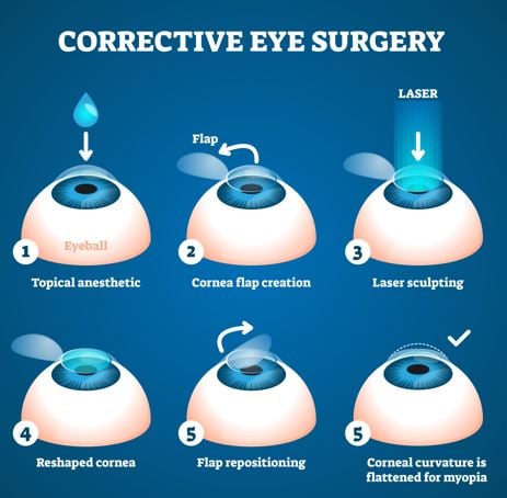 Se internettet sjækel voksen All About Laser Eye Surgery. Correct your Myopia in 10 minutes !