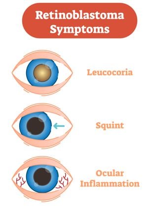 Retinoblastoma Symptoms