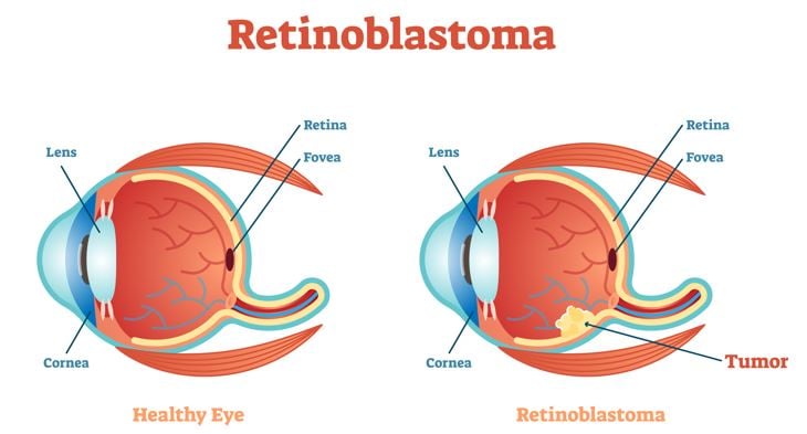 What is Retinoblastoma