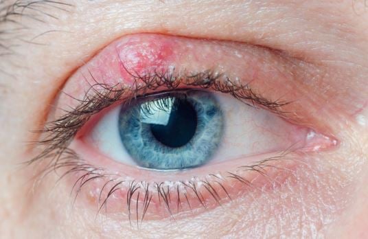 What is a chalazion