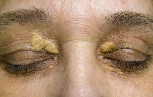 What is xanthelasma