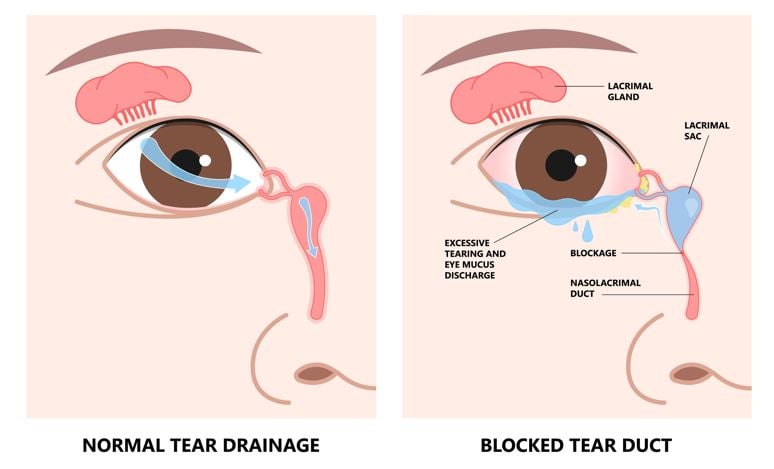 Blocked tear duct