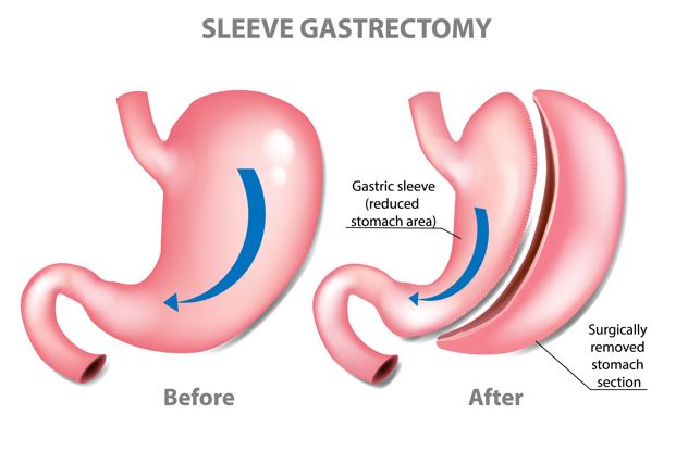 Gastric sleeve Surgey MSB